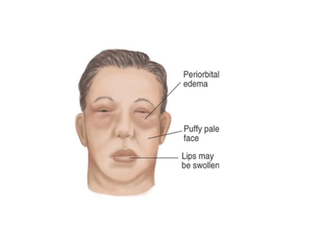 symptoms