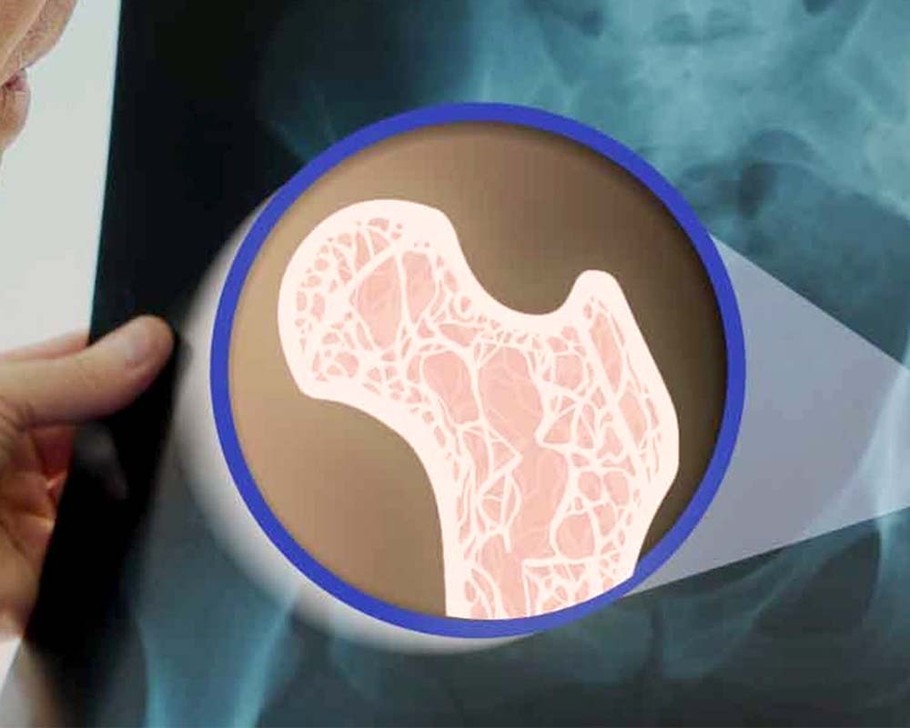 osteoporosis1