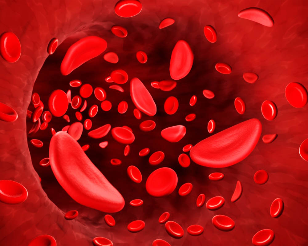 anemia4 anemia4