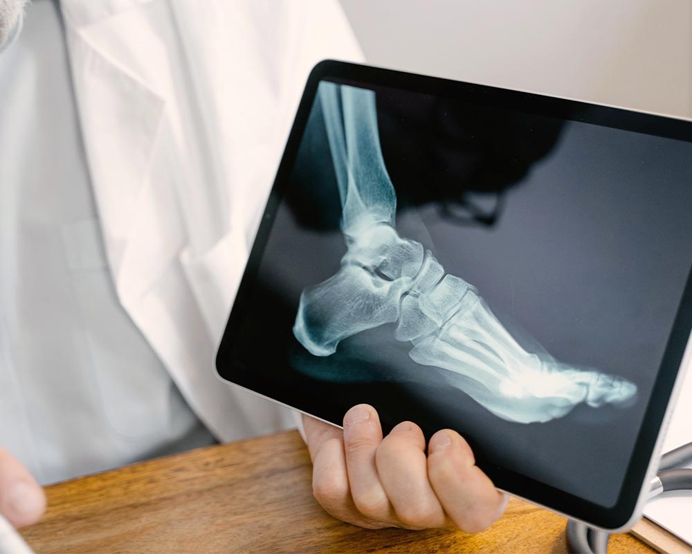 osteoporosis4 osteoporosis4